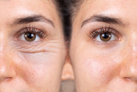 Före/efter bild botox